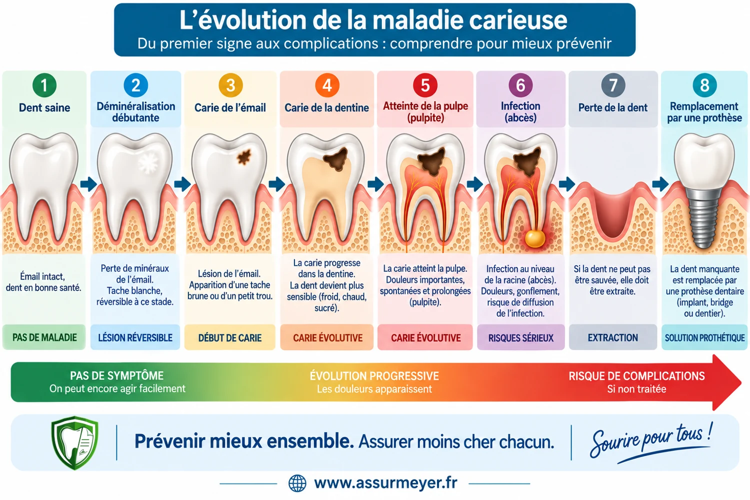 Les étapes possibles de l’évolution d’une carie dentaire